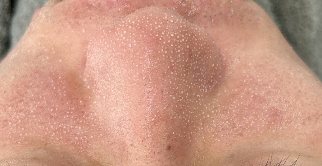 毛穴セラムをつけて約10分後、小鼻の角栓が白く浮き上がった様子